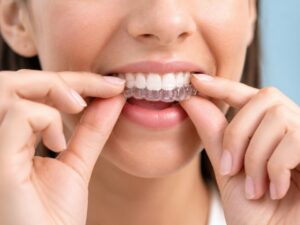 Woman placing a clear aligner over her upper teeth.